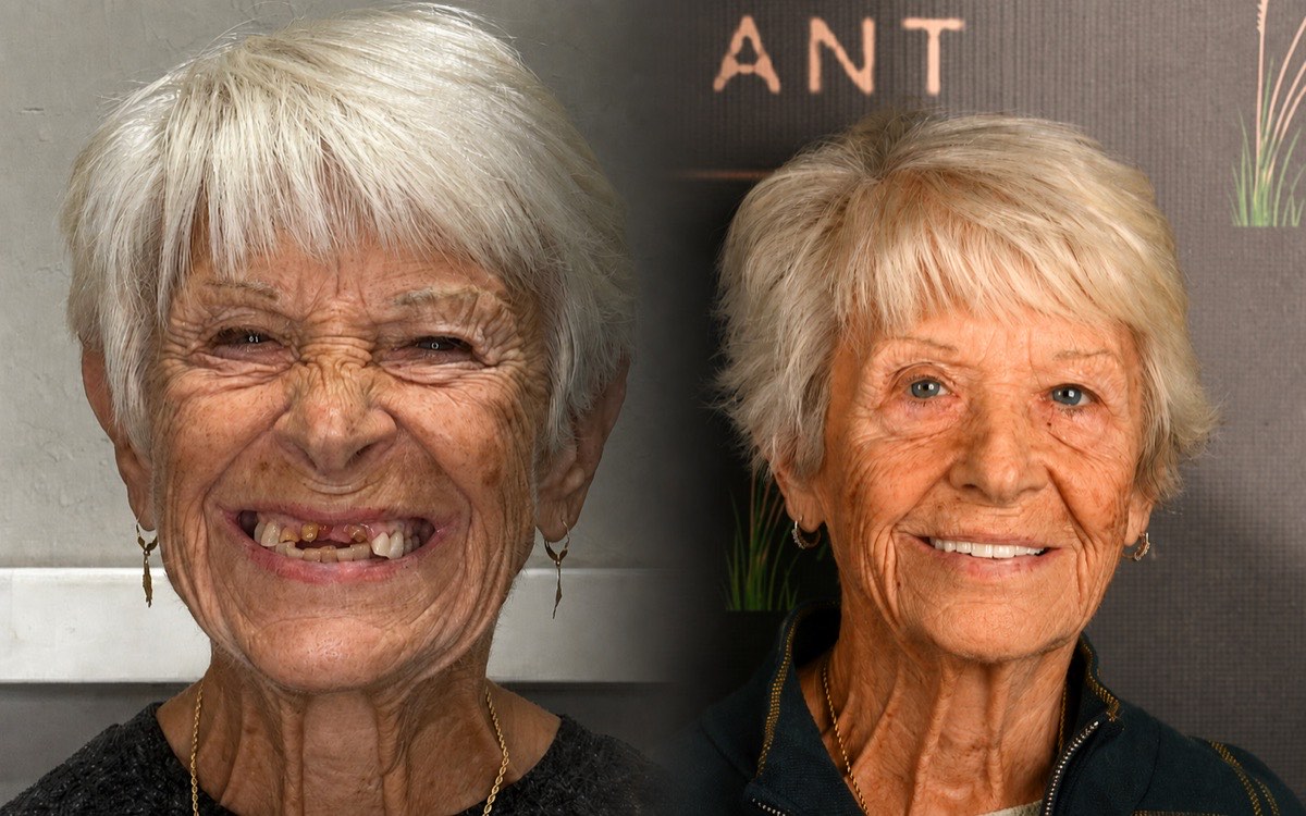 Marsh Cove patient before and after full-mouth dental implants