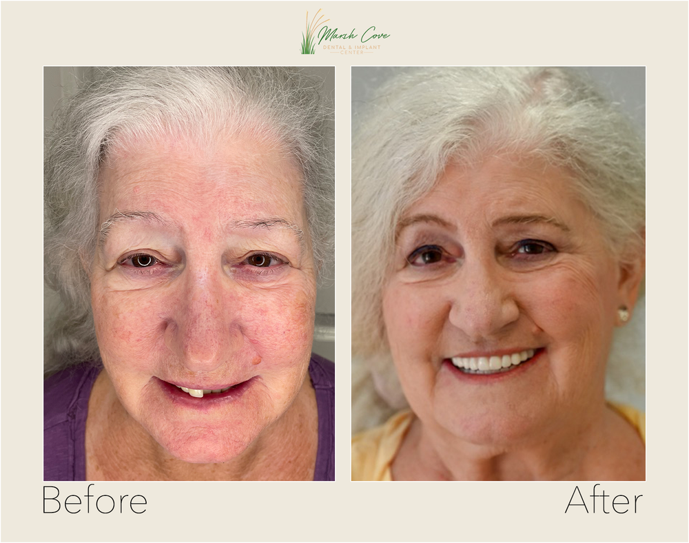 Before and after dental implant transformation - Full-Arch Restoration — Upper & Lower