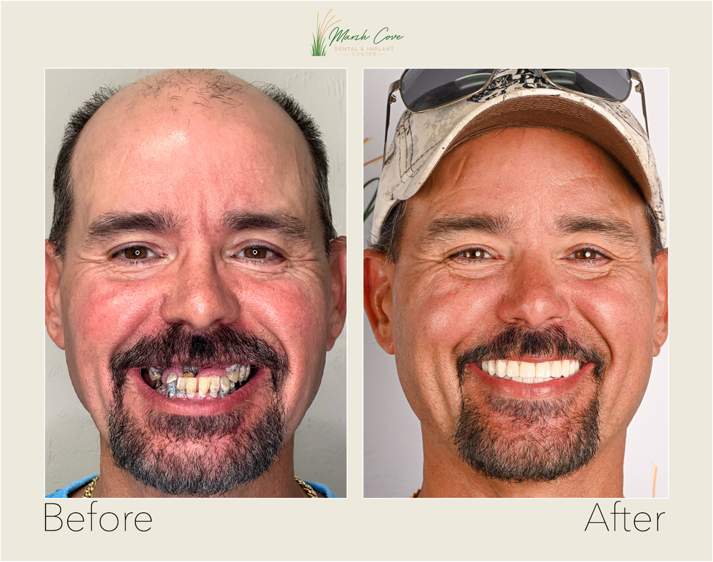 Before and after dental implant transformation - Complete Smile Makeover — Upper Arch