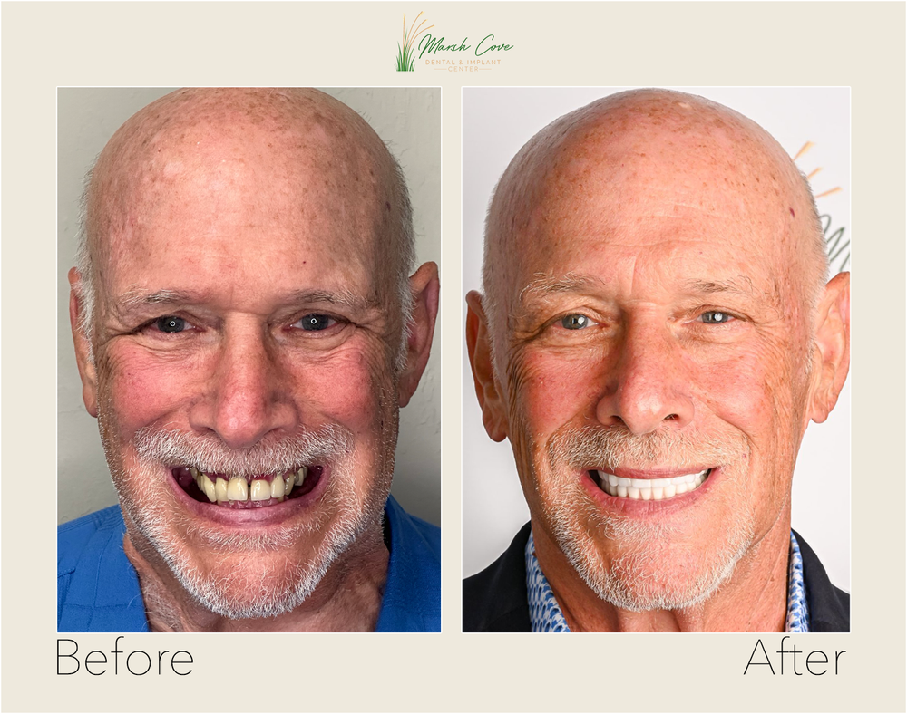 Before and after dental implant transformation - Full-Arch Restoration — Upper & Lower